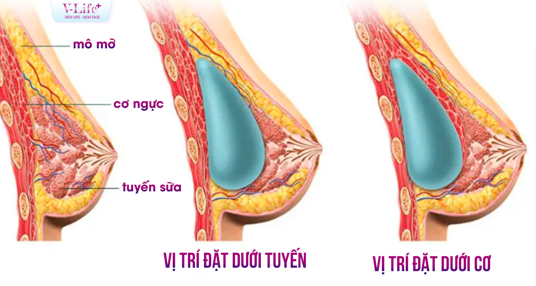 Đặt túi ngực dưới cơ hay dưới tuyến? Phương pháp nào phù hợp với bạn?