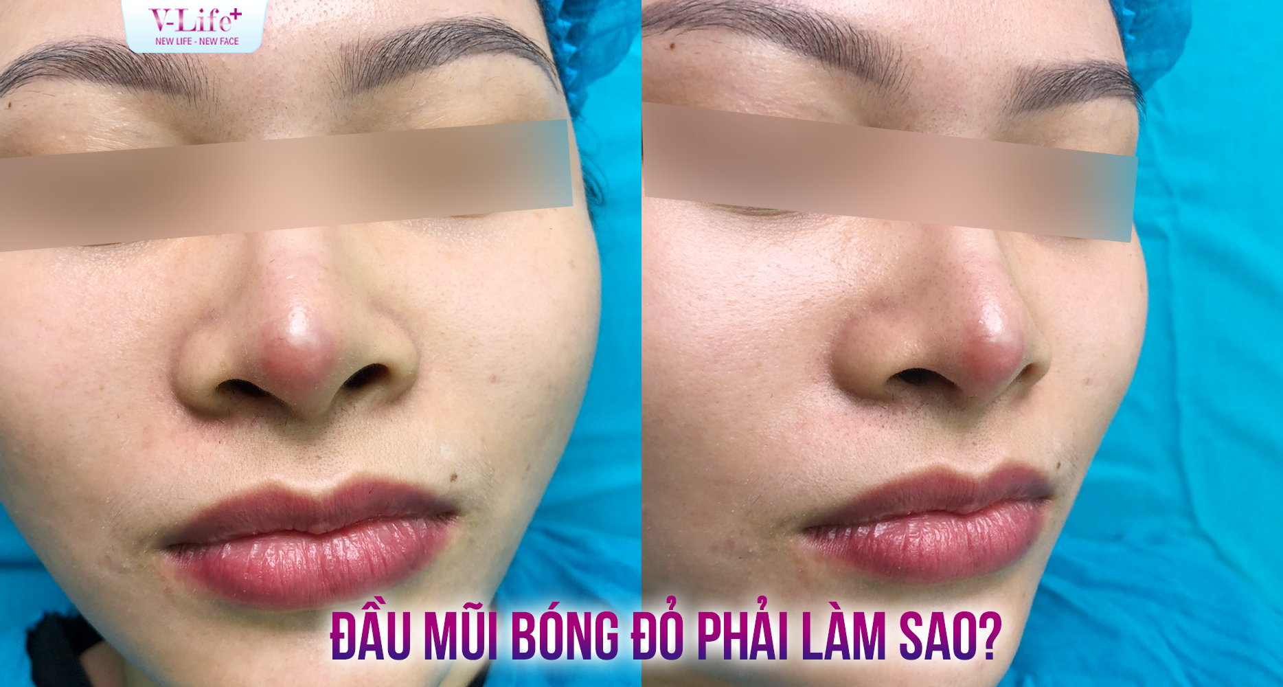 Đầu mũi bóng đỏ sau nâng mũi: Nguyên nhân và cách khắc phục