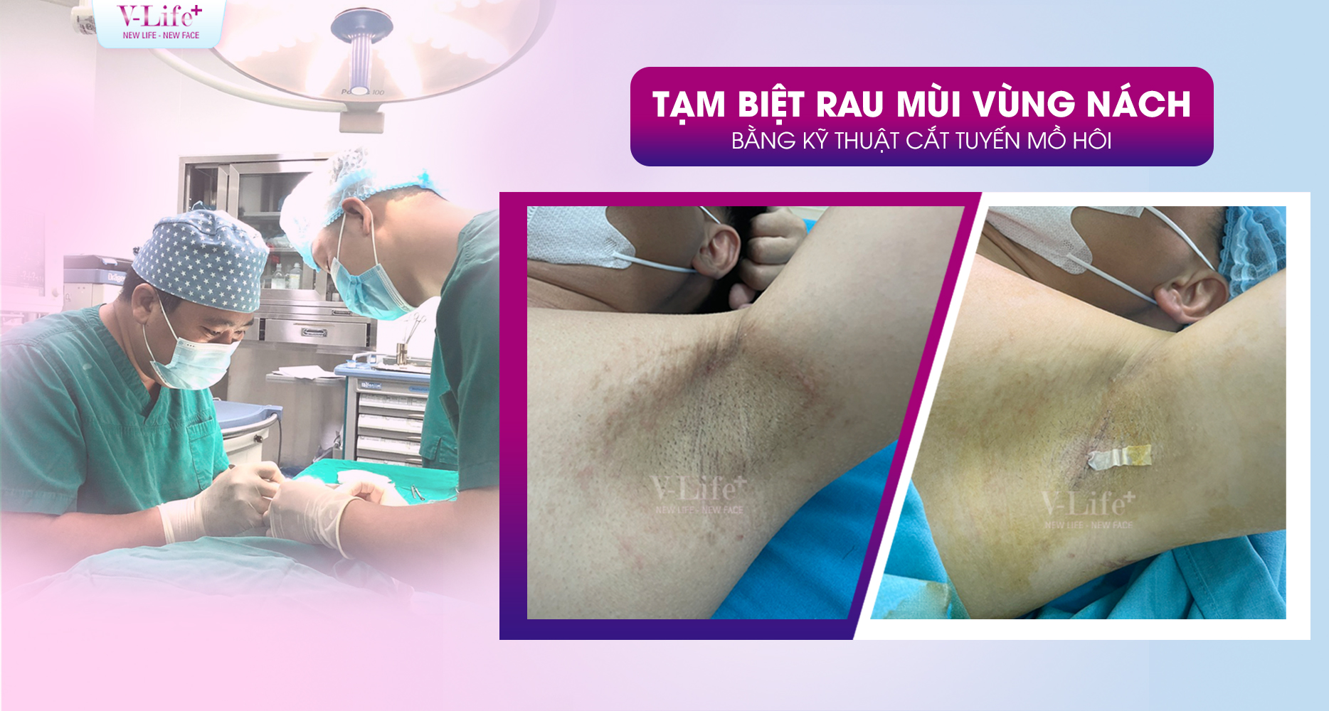 Hôi nách nguyên nhân do đâu? Làm thế nào để cải thiện hiệu quả?