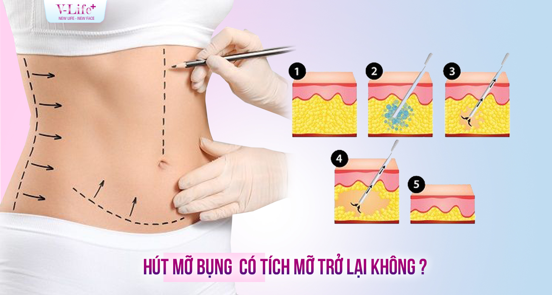 Hút mỡ bụng có tích mỡ trở lại không? Hiểu đúng để duy trì vóc dáng lâu dài