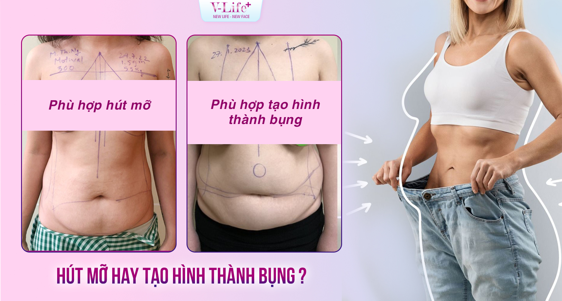 Hút mỡ và tạo hình thành bụng khác nhau như thế nào? Cách lựa chọn phương pháp phù hợp