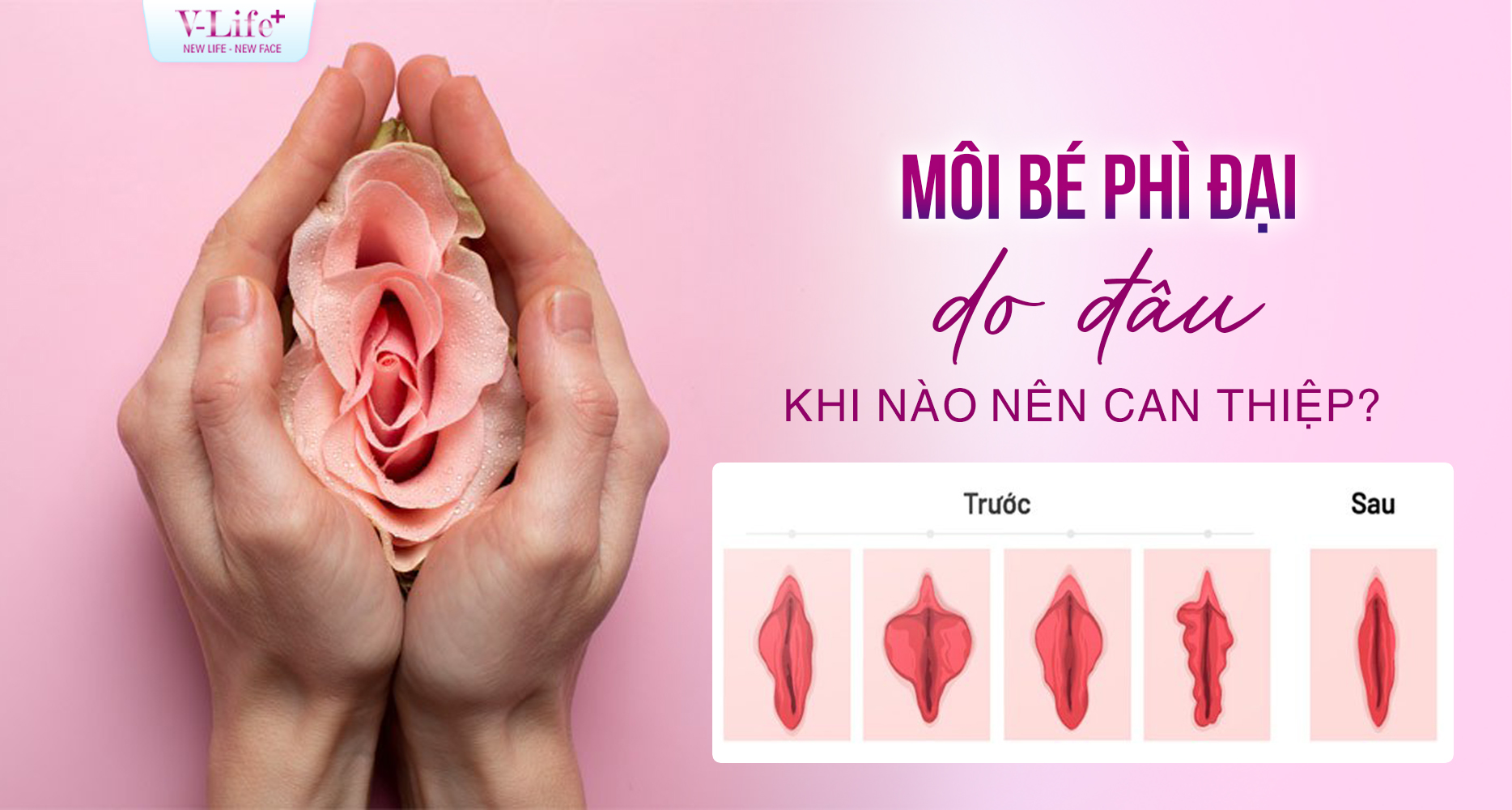 Môi bé dài, phì đại có ảnh hưởng gì không? Khi nào nên thu nhỏ?