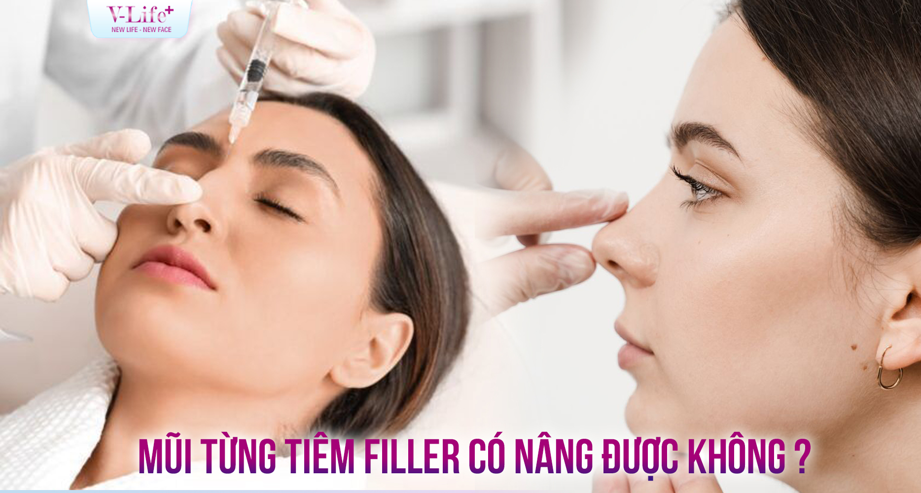 Mũi từng tiêm filler có nâng được không?