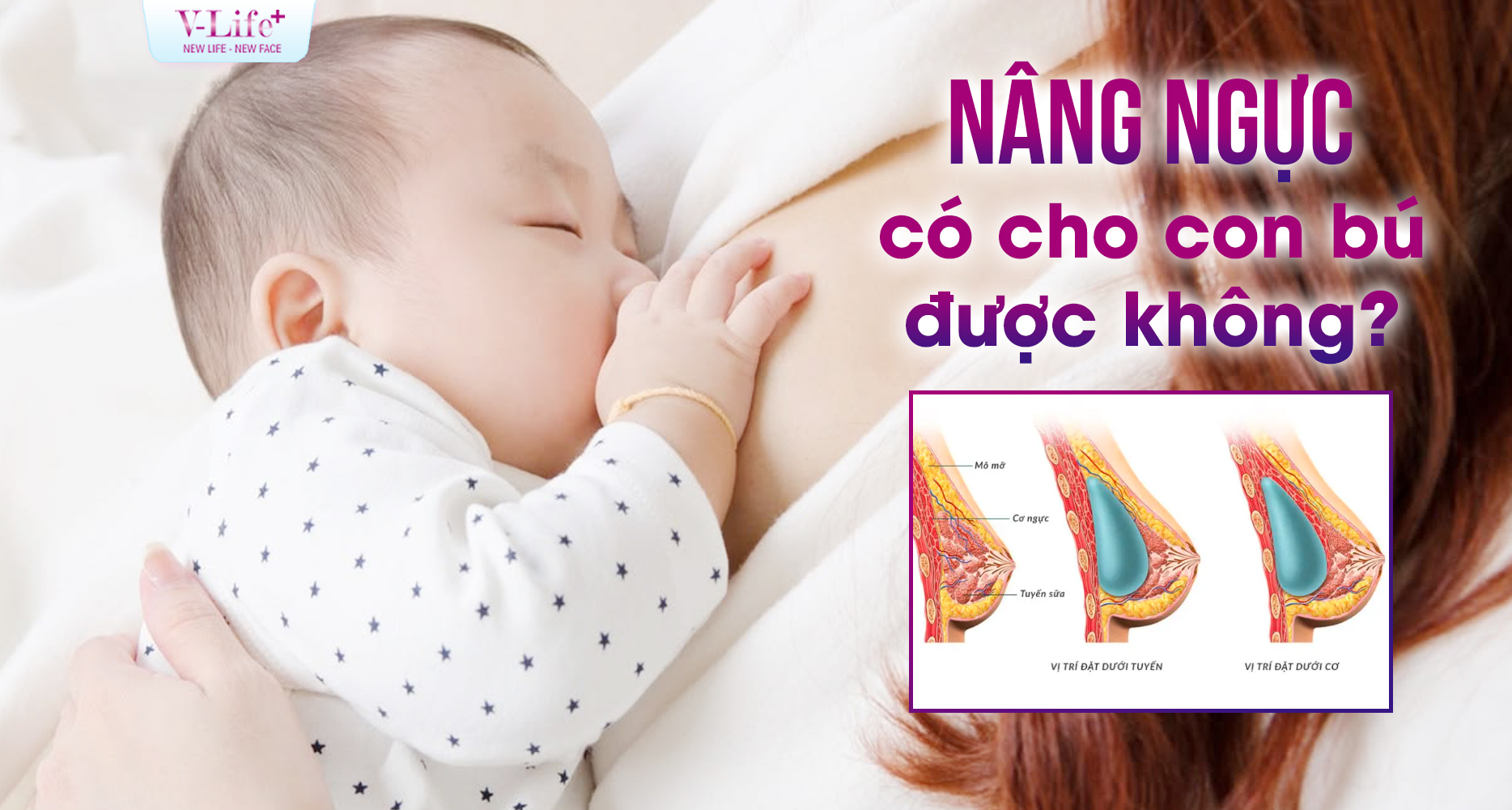 Nâng ngực có cho con bú được không? Giải đáp từ góc độ chuyên môn