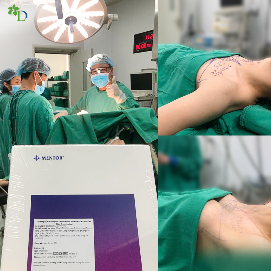 Nâng ngực có đau không? Những điều bạn nên biết trước khi quyết định thực hiện