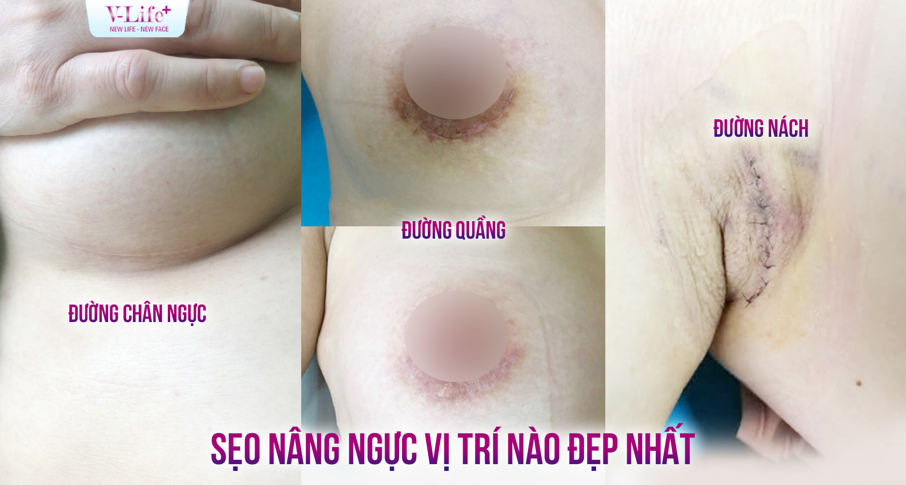 Nâng ngực có để lại sẹo không? Vị trí nào giúp sẹo đẹp và khó nhận thấy?