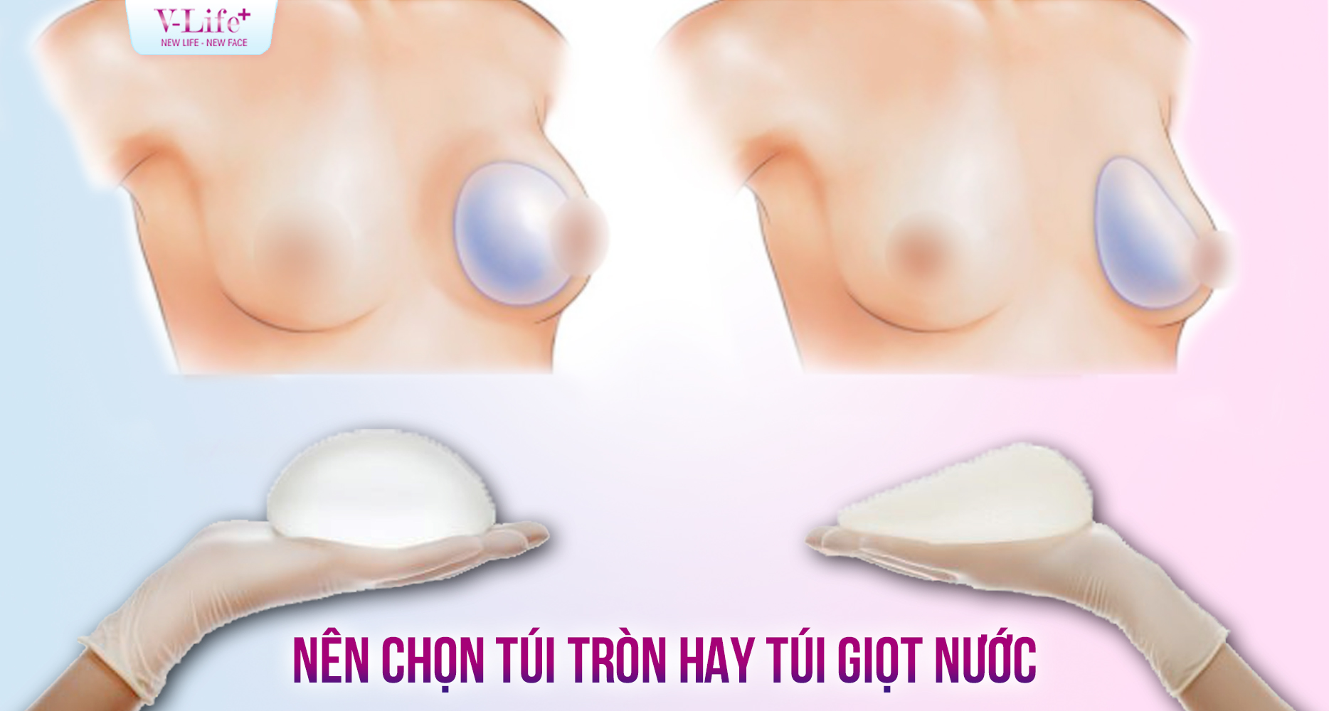 Nâng ngực nên chọn túi tròn hay túi giọt nước?