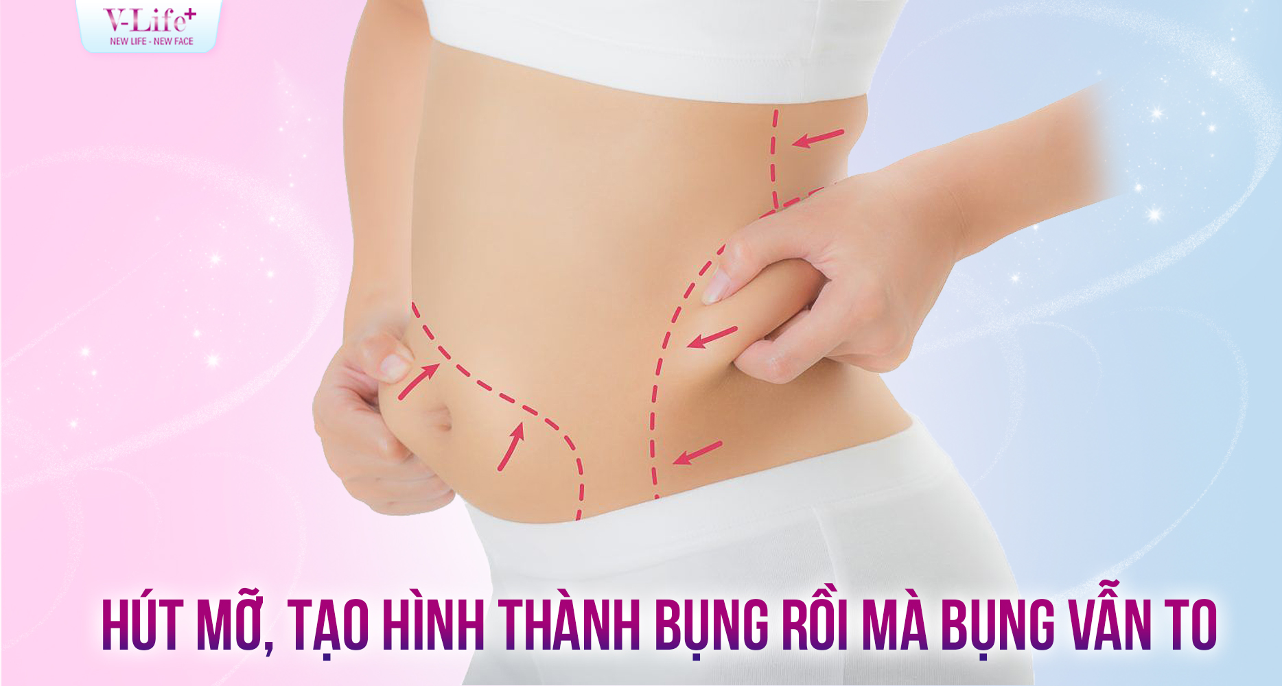 Vì sao có người hút mỡ kết hợp tạo hình thành bụng rồi mà bụng vẫn to?